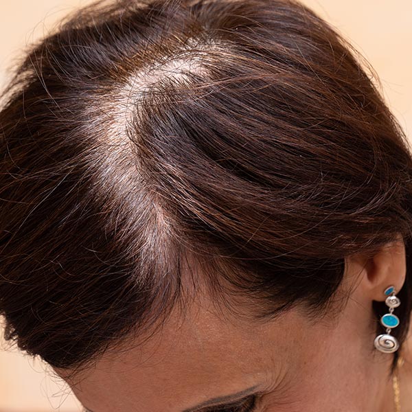 Micropigmentation pour femme, feminine,DPC - Dermopigmentation capillaire à Saint-Nazaire, Hair Tattoo, micro-pigmentation des cheveux, tatouage cheveux, micro-tatouage contre la calvitie