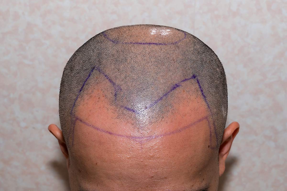 effet crâne rasé homme femme DPC Dermopigmentation pour Hommes capillaire Saint-Nazaire, Hair Tattoo, micro-pigmentation des cheveux, tatouage cheveux, micro-tatouage contre la calvitie