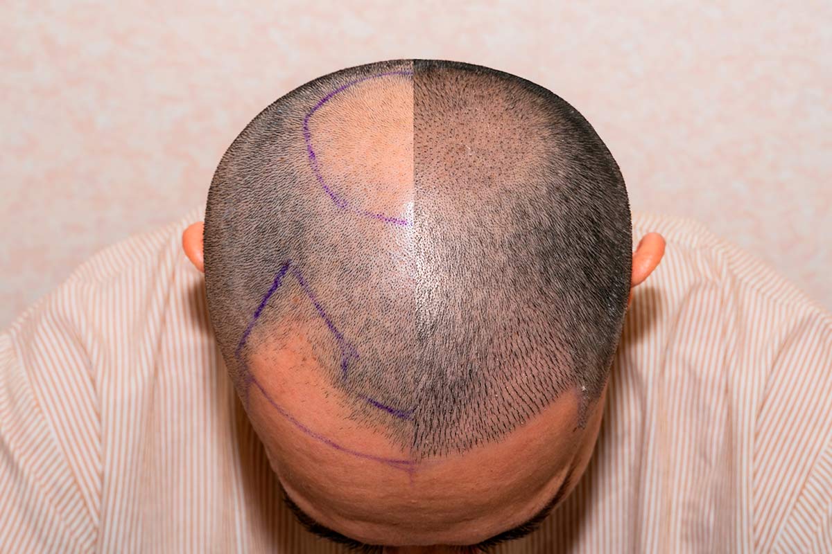 effet crâne rasé homme femme DPC Dermopigmentation pour Hommes capillaire Saint-Nazaire, Hair Tattoo, micro-pigmentation des cheveux, tatouage cheveux, micro-tatouage contre la calvitie