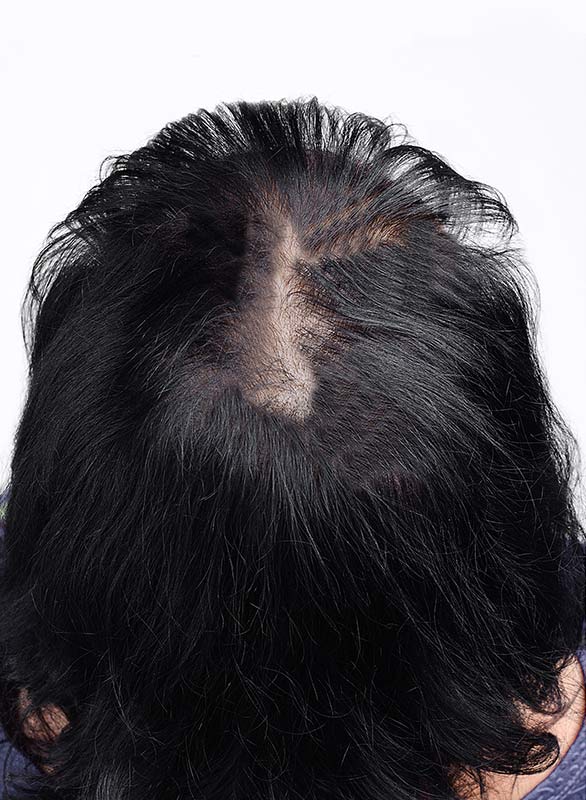 Micropigmentation pour Femme, DPC BY FRED - Dermopigmentation Capillaire à Saint-Nazaire