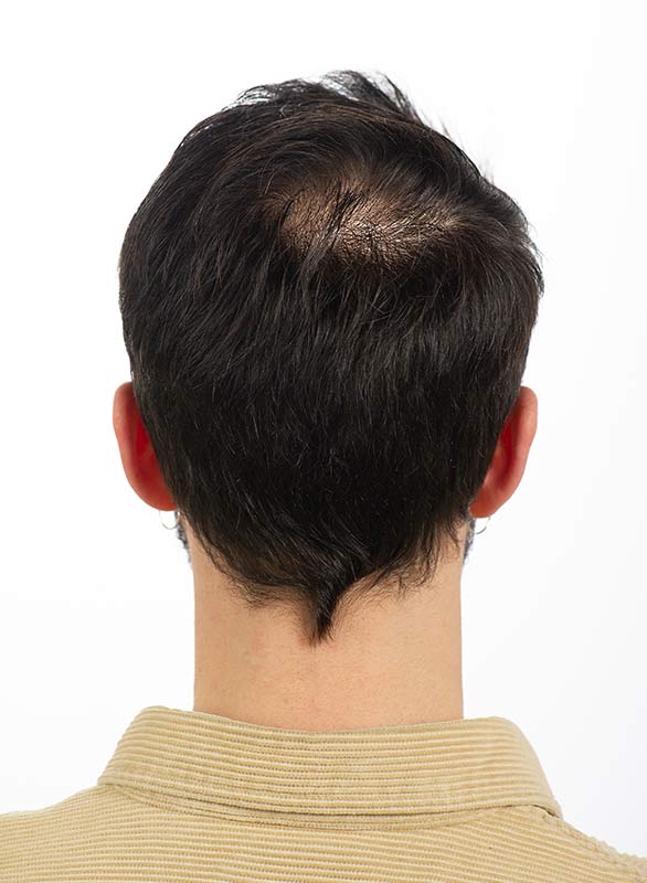 Avant et après Micropigmentation pour Homme, DPC BY FRED - Dermopigmentation Capillaire Hommes à Saint-Nazaire