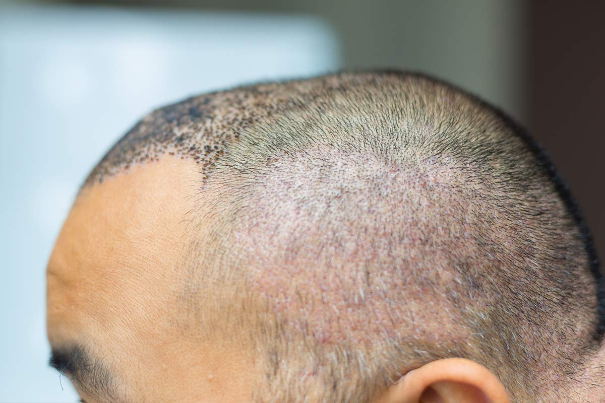 effet crâne rasé homme femme DPC Dermopigmentation pour Hommes capillaire Saint-Nazaire, Hair Tattoo, micro-pigmentation des cheveux, tatouage cheveux, micro-tatouage contre la calvitie