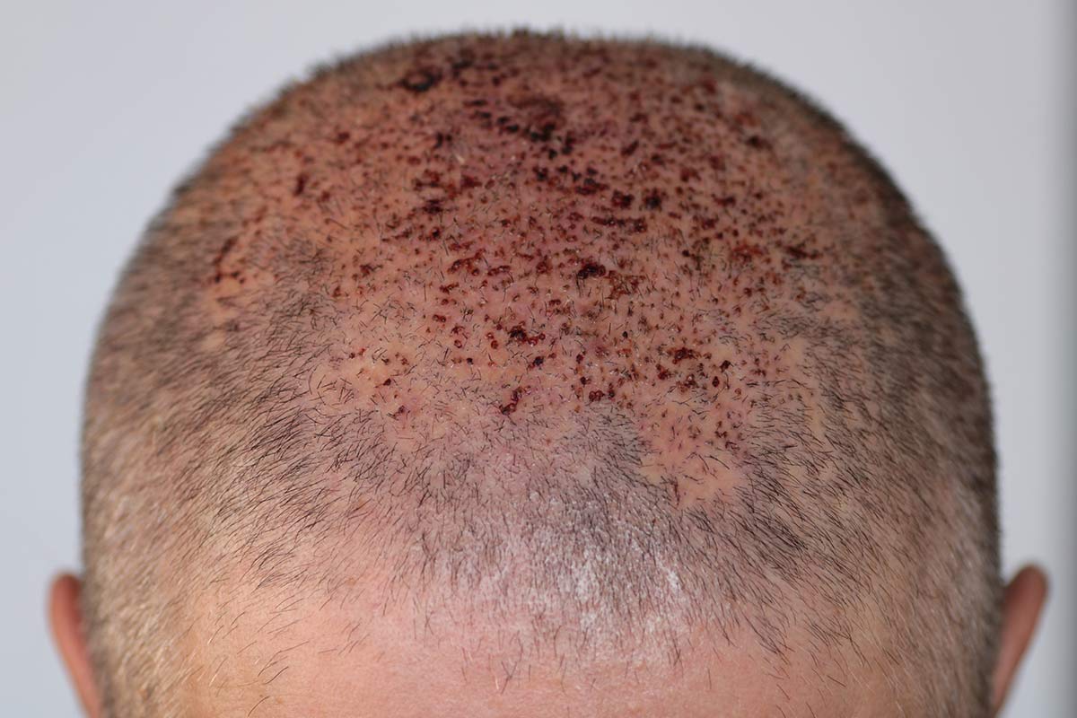 effet crâne rasé homme femme DPC Dermopigmentation pour Hommes capillaire Saint-Nazaire, Hair Tattoo, micro-pigmentation des cheveux, tatouage cheveux, micro-tatouage contre la calvitie